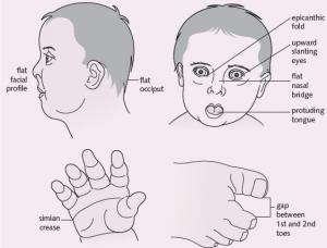 علائم سندروم داون در نوزادان تازه متولد شده